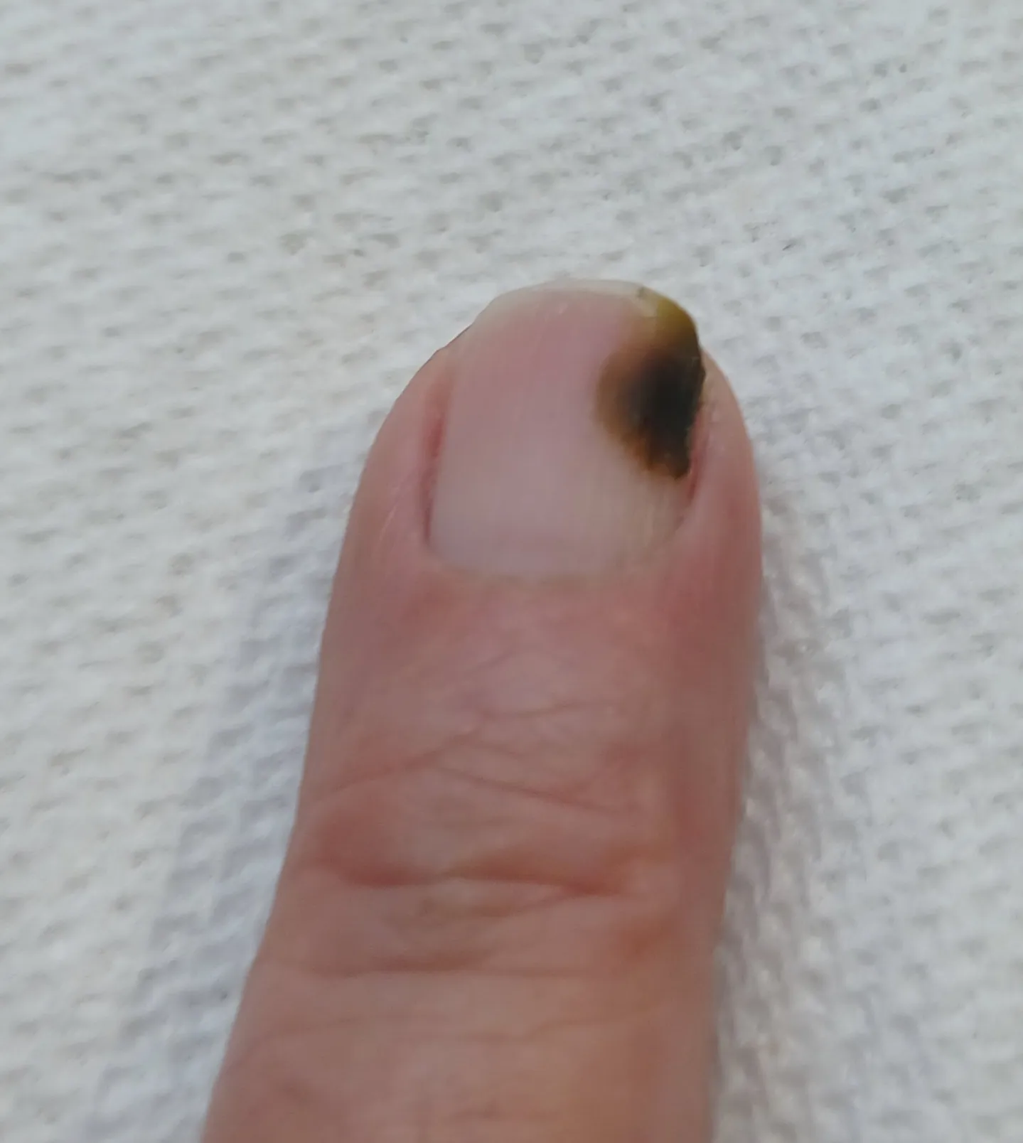 Zainfekowany manicure - jak rozpoznać zieloną bakterię i uratować płytkę paznokcia