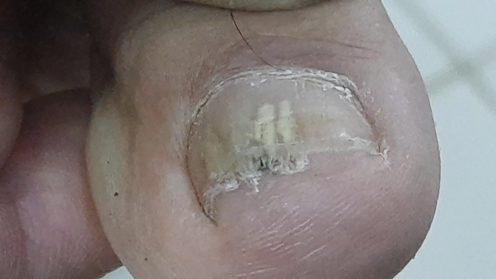 Fungal infected nail in KOH mount shown fungalelements