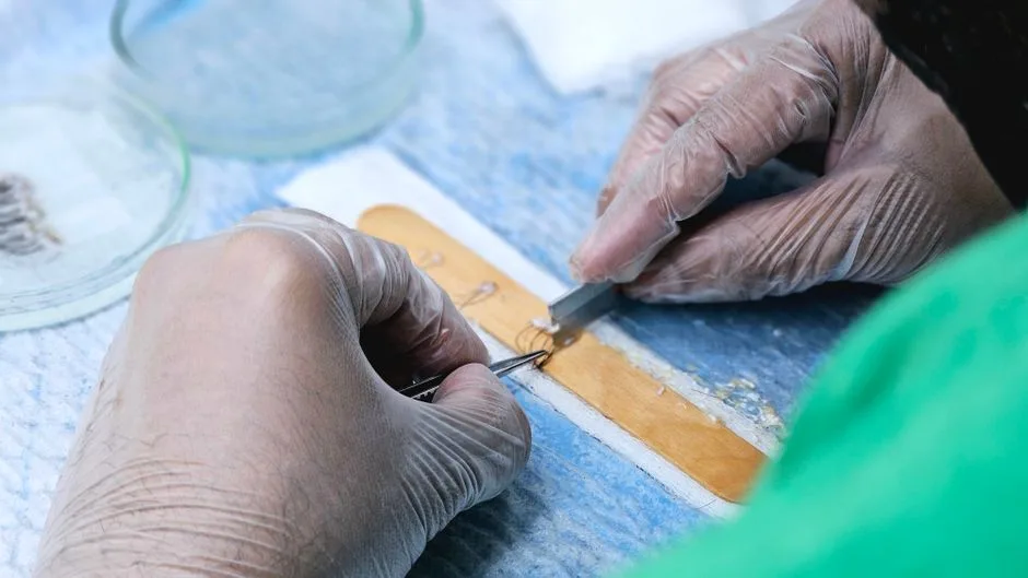 Detailed view of a hair transplant procedure with gloved hands holding surgical tools indoors.